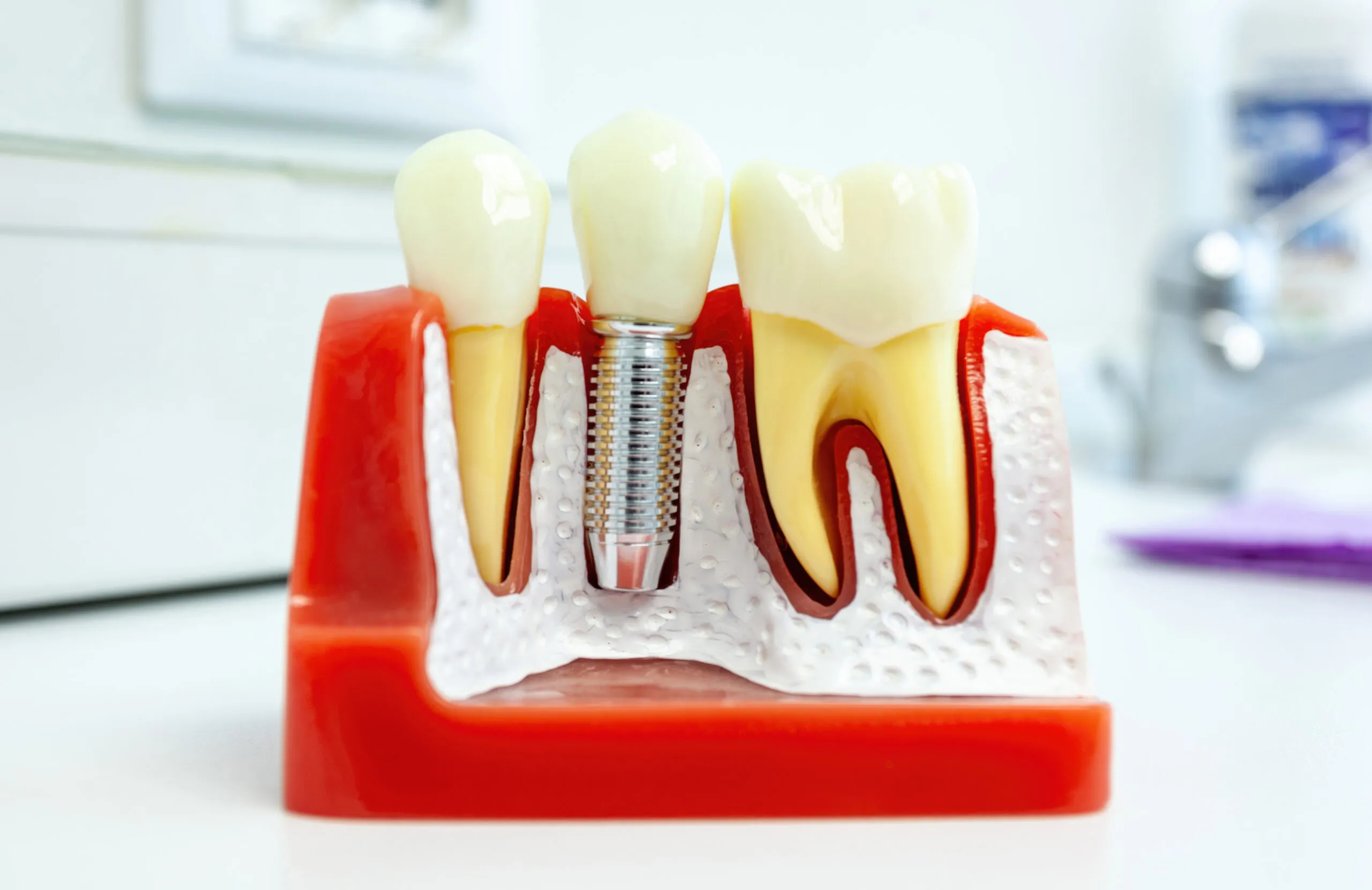 Urgent Care for Dental Implants